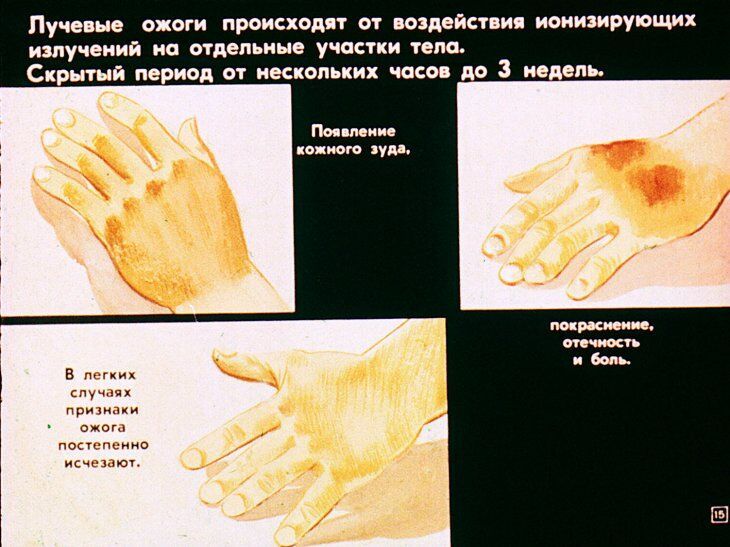 Первая медицинская помощь при радиационных и комбинированных поражениях. Диафильм СССР 1981