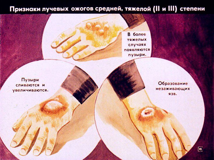 Первая медицинская помощь при радиационных и комбинированных поражениях. Диафильм СССР 1981